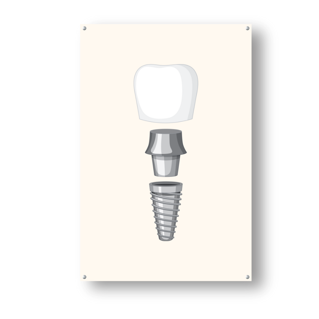 Fragmented Dental Implant - Dr Picture