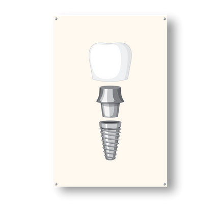 Fragmented Dental Implant - Dr Picture