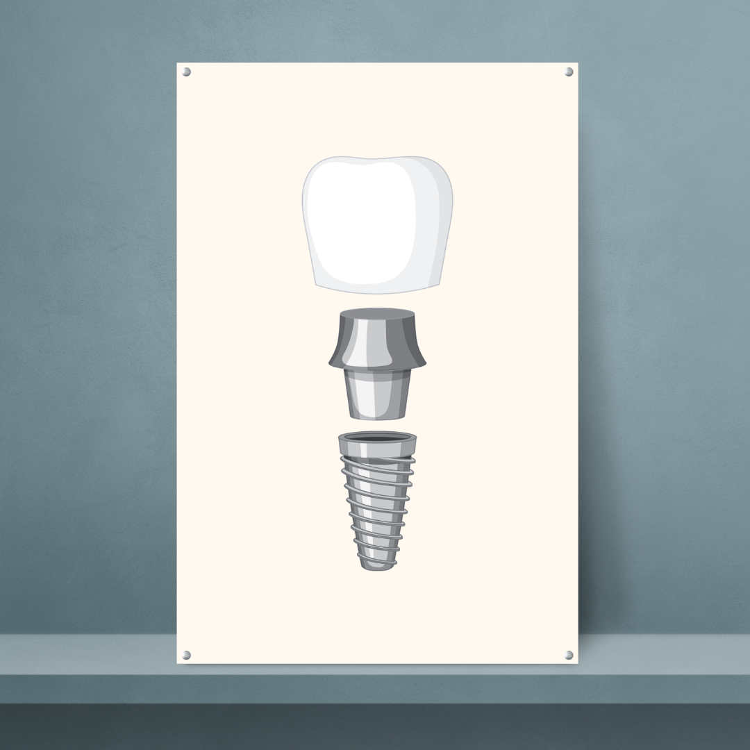 Fragmented Dental Implant - Dr Picture